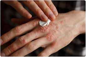 Know More About Eczema/Dermatitis